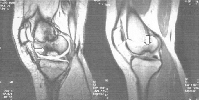 X-ray of osteochondritis dissecans in the knee joint