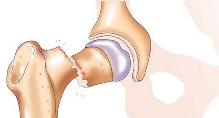 A fracture of the femoral neck is associated with severe pain in the hip joint