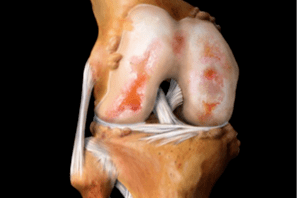 Damage to the knee joint due to osteoarthritis