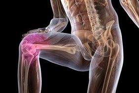 Joint pain due to knee osteoarthritis