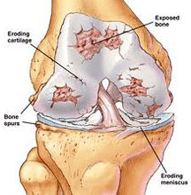 The development mechanism of arthrosis